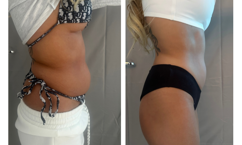 Sculpt Elite Body Refresh Package