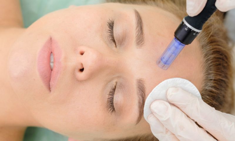 Micro Needling facial at Advanced Clinical Perfection by Karen at The Yealand Clinic